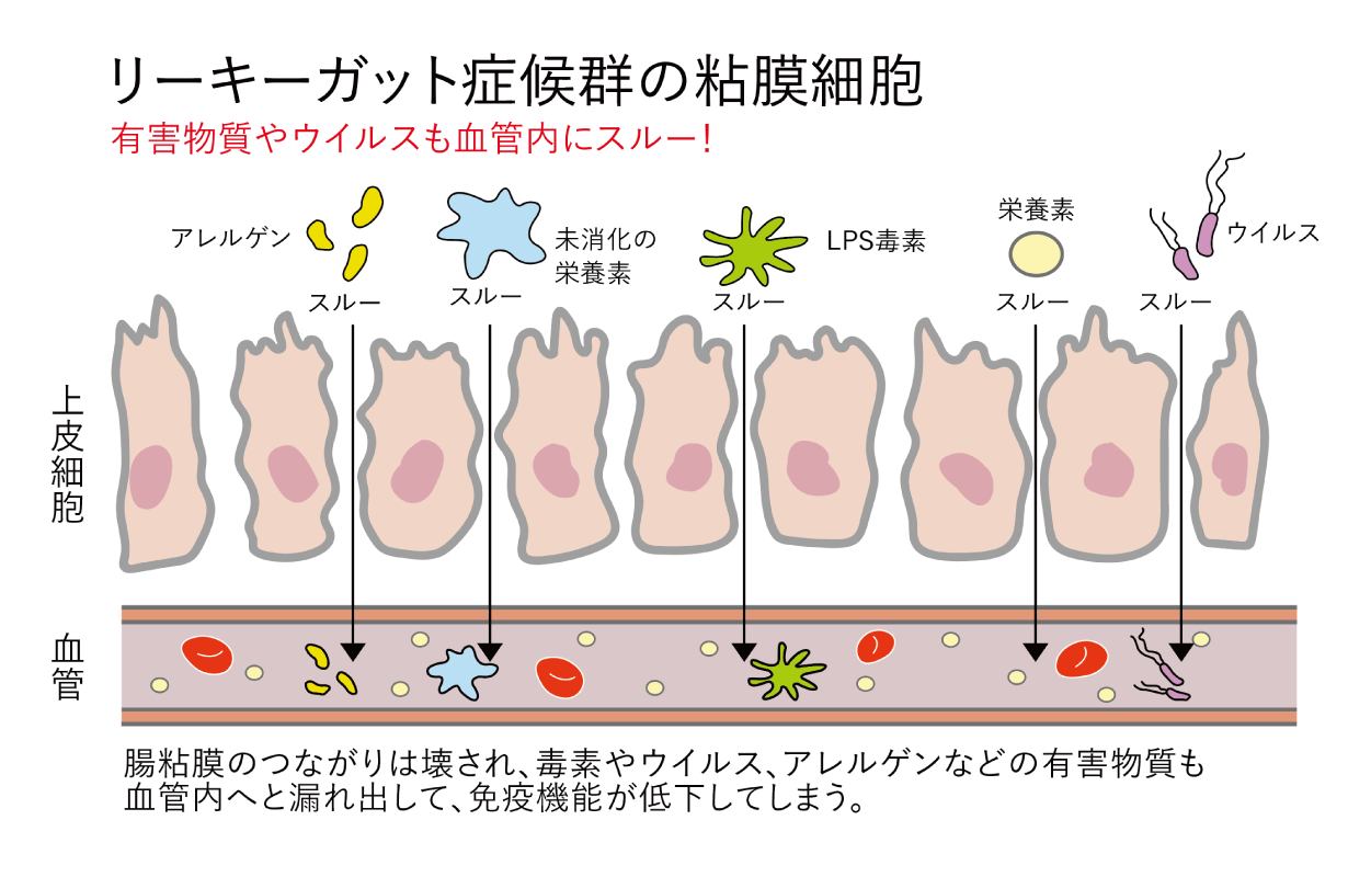 リーキーガット症候群の粘膜細胞